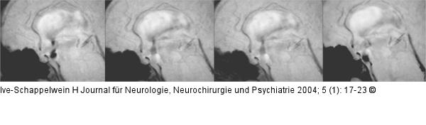 Hydrozephalus beim Erwachsenen