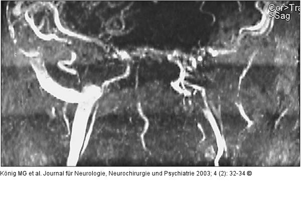 Vena jugularis - Thrombose