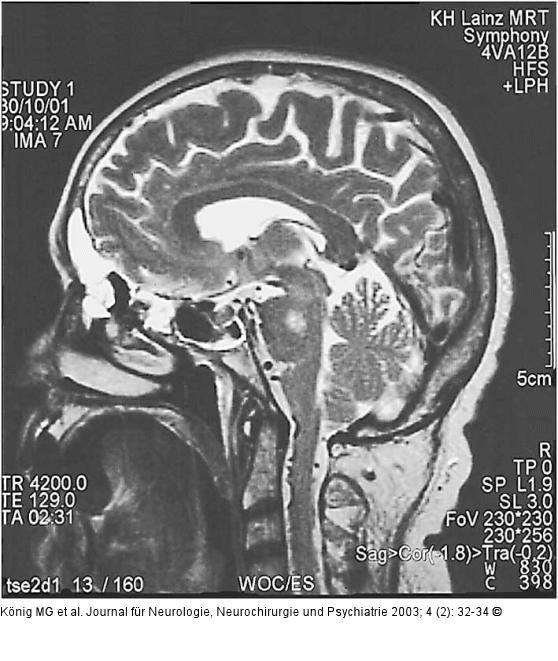 Sinusitis frontalis