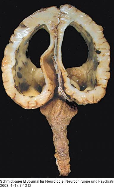 Ventrikulomegalie