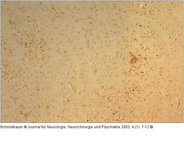 Herpes simplex - Hirnstammenzephalitis