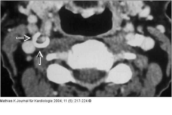 Karotisstenose