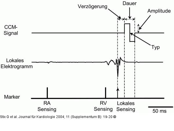 Kardiale Kontraktilitätsmodulation