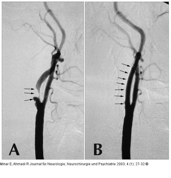 Arteria carotic - Stenose - Stent