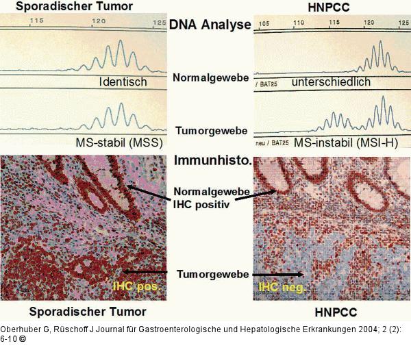 Kolonkarzinom - HNPCC-Syndrom