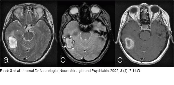 Intrazerebrale Blutung