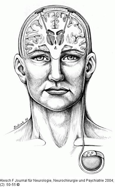 Tiefe Hirnstimulation