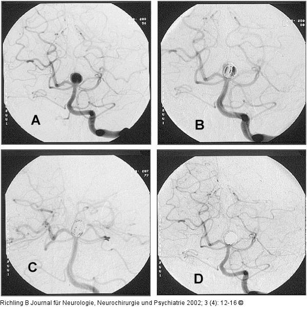 Aneurysma - Coil