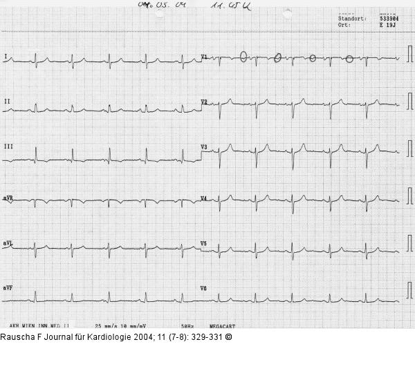 Sinusrhythmus mit zusätzlicher Vorhoferregung