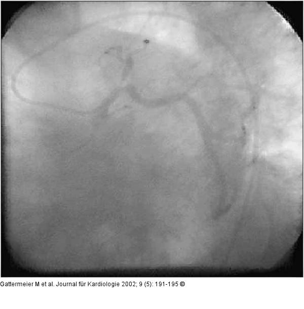 Subakute Stentthrombose - Fallbericht