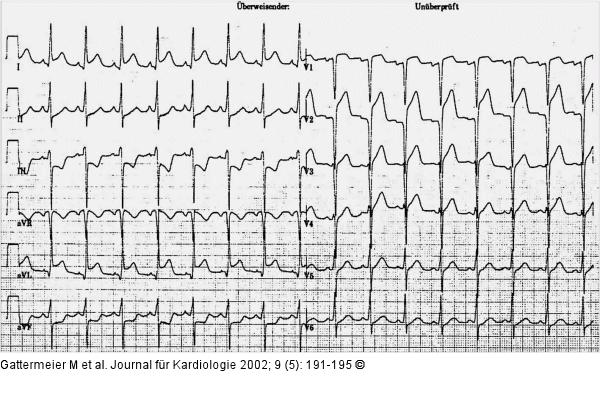 Subakute Stentthrombose - Fallbericht