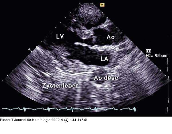 Polyzystische Nephropathie