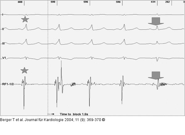 Paroxysmale Tachyarrhythmie