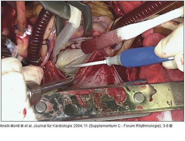 Radiofrequenzablation - Operationssitus