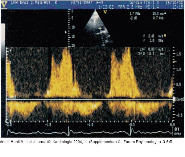 HF-Ablation - Transmitrales Flußmuster