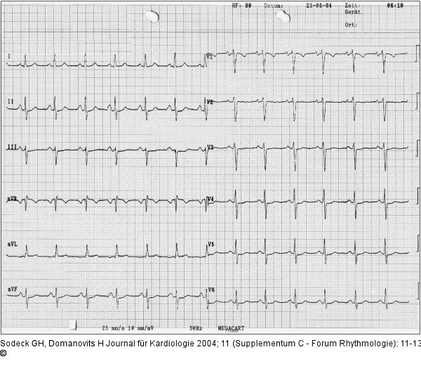 EKG - Sinusrhythmus