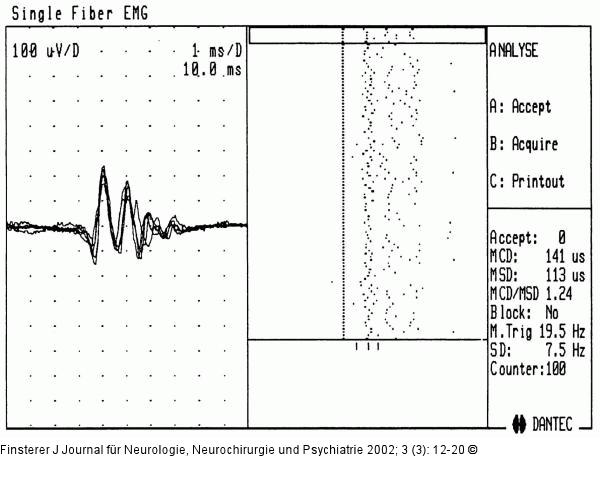 Einzelfaserelektromyographie - ALS