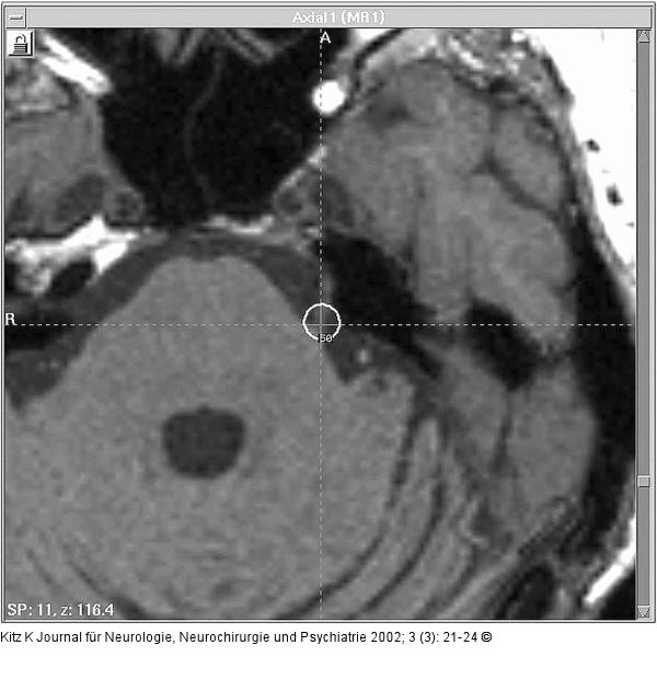 Gamma Knife - Dosisplan