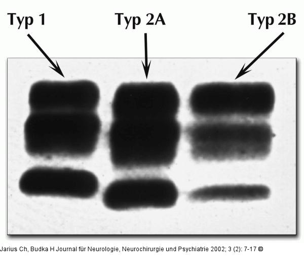 Spongiforme Enzephalopathie - Prionprotein-Glykoformen