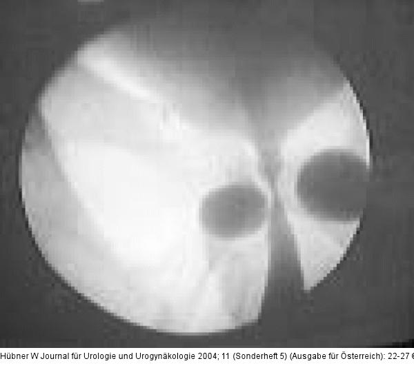 Pro-ACT-Implantation - UCG