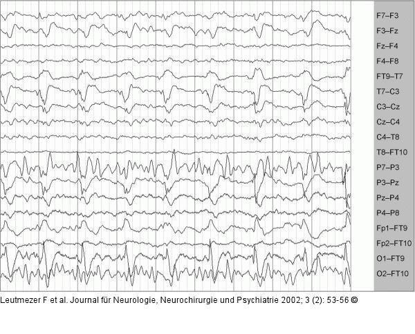 EEG - PLEDs