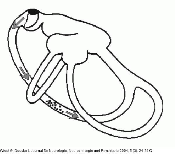 Canalolithiasis - Mechanismus