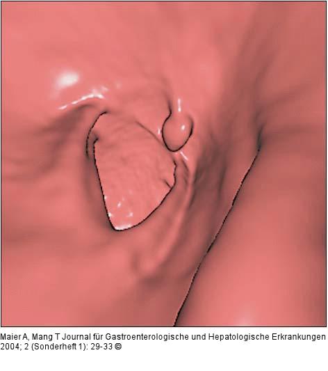 Sigma - 9 mm Polyp