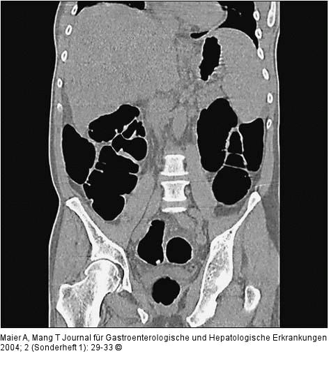 Sigma - 9 mm Polyp