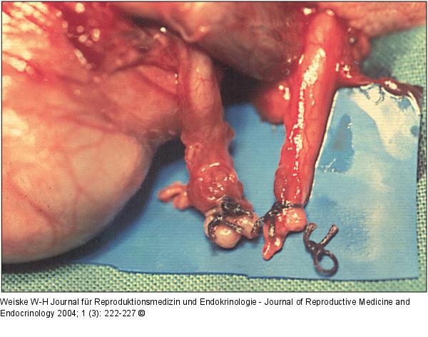 Vasovasostomie