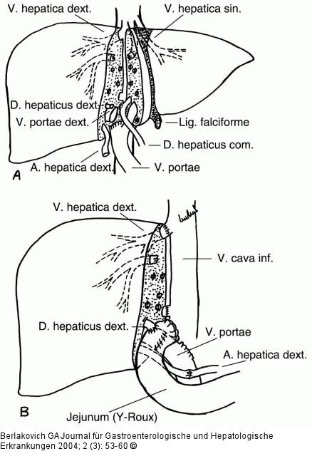 Lebertransplantion - Operation
