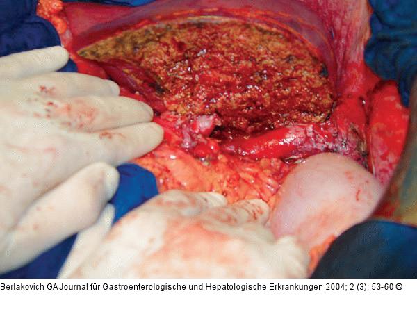 Lebertransplantation - Empfängeroperation