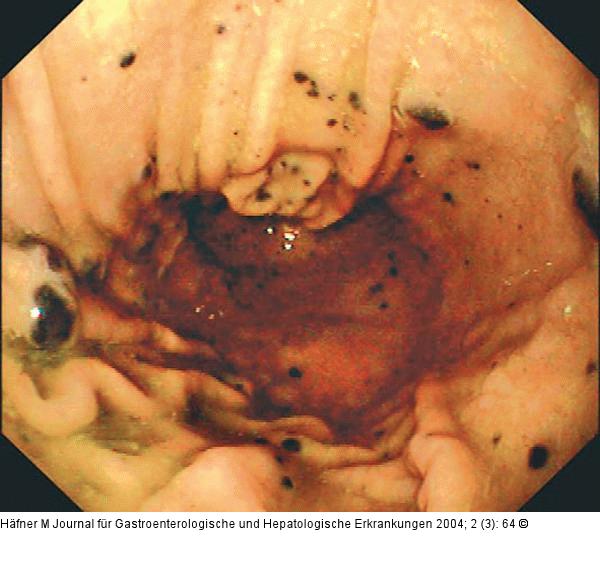 Corpus ventriculi