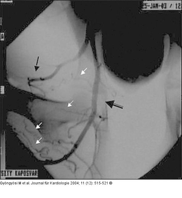 Arteria femoralis - Initiale Kollateralisation