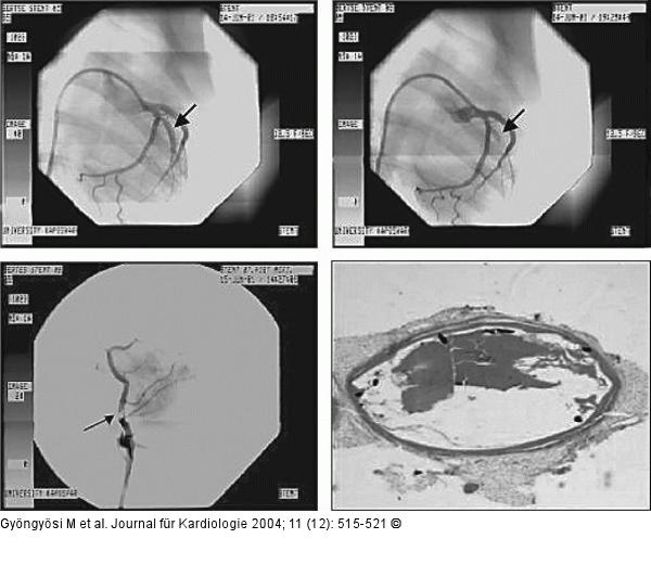 Stentthrombose