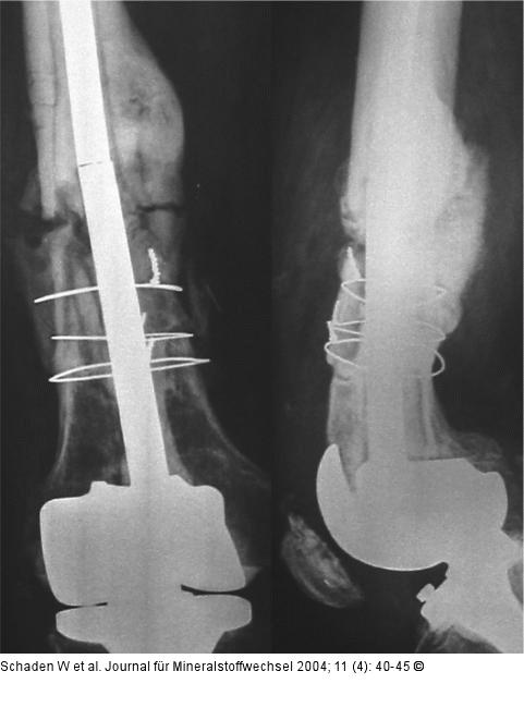 Kniegelenksprothese
