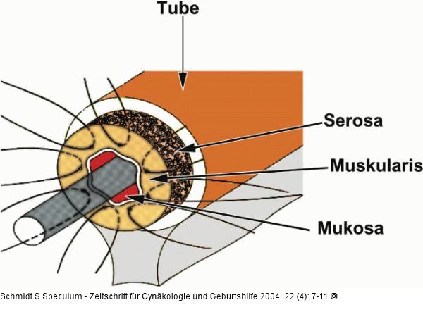 Refertilisierung - Tubenanastomose