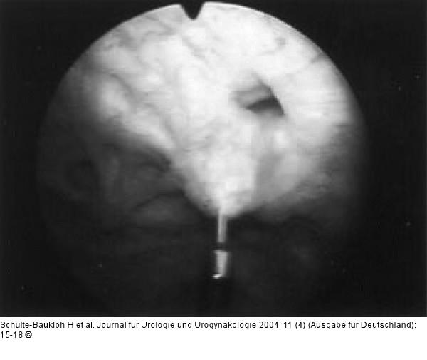 Botulinumtoxin-A