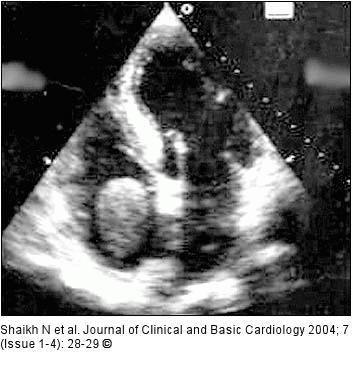 Transthoracic echocardiography