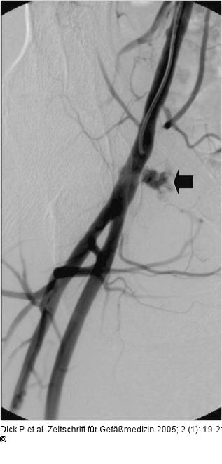 Iatrogenes Pseudoaneurysma