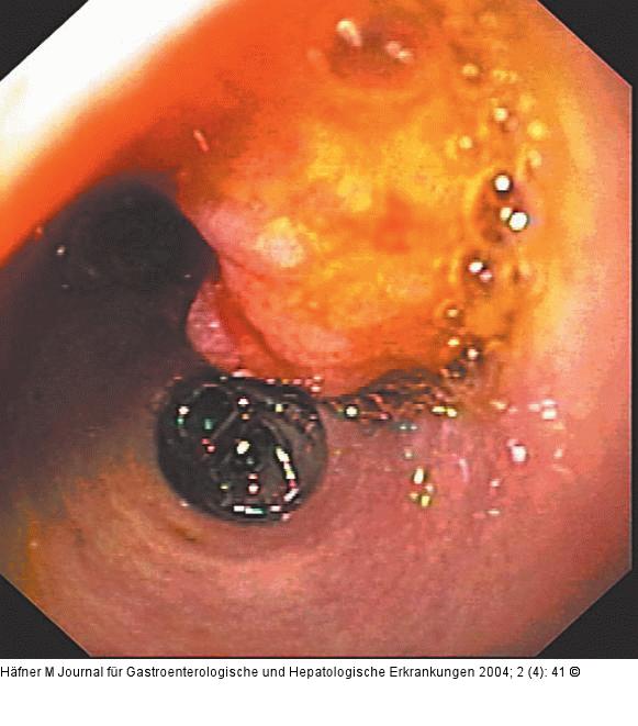 Ductus hepaticus