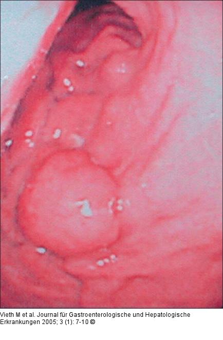 PGA - Endoskopischer Videoprint