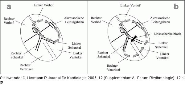 Tachykardien - Zykluslänge