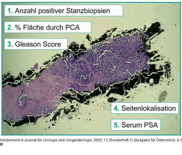 Prostatakarzinom - Subgruppenidentifikation