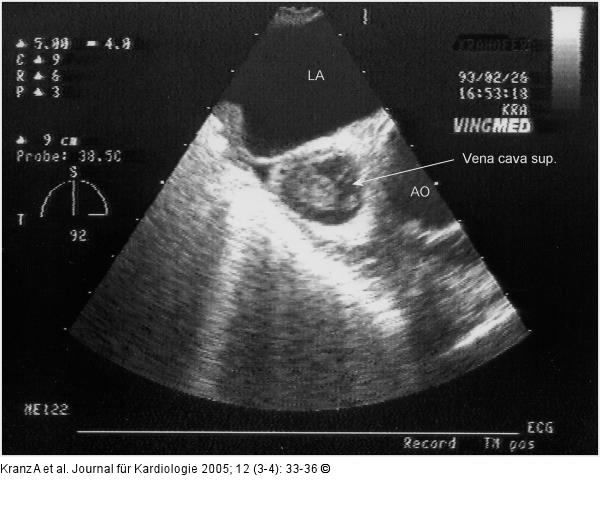 Vena cava sup. - Subtotale Thrombose