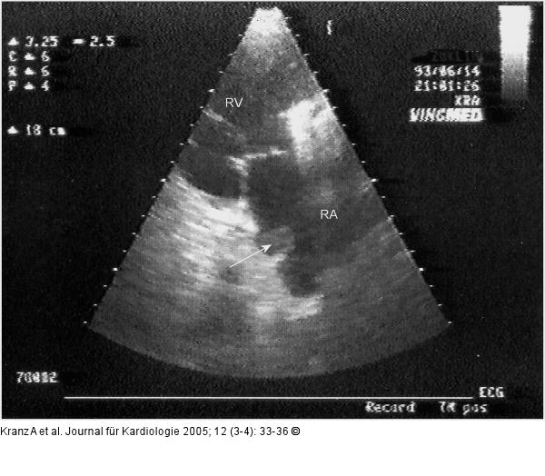 Kugelthrombus