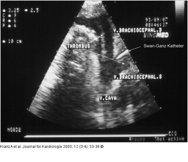 Flottierender Thrombus