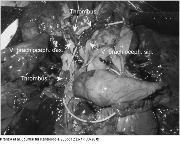 Flottierender Thrombus
