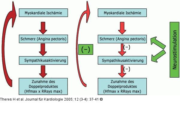 Neurostimulation - Schmerz