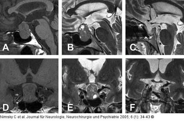 Hypophysenadenom