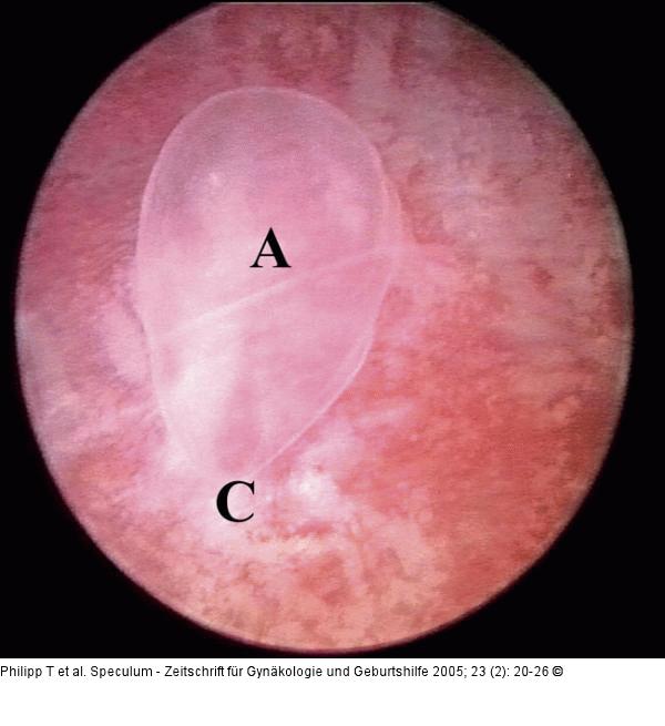 GD1-Embryo